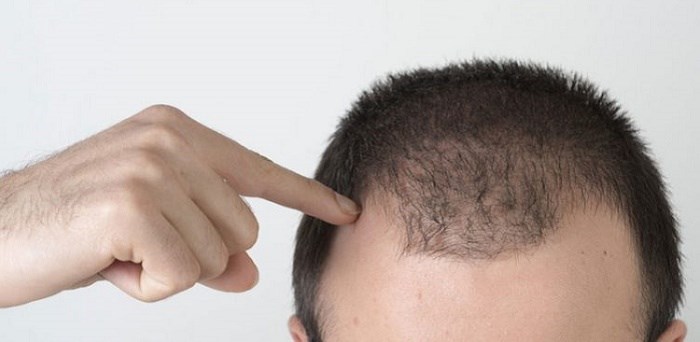 ریزش مو یکی از علائم ابتلا به کرونا است؟