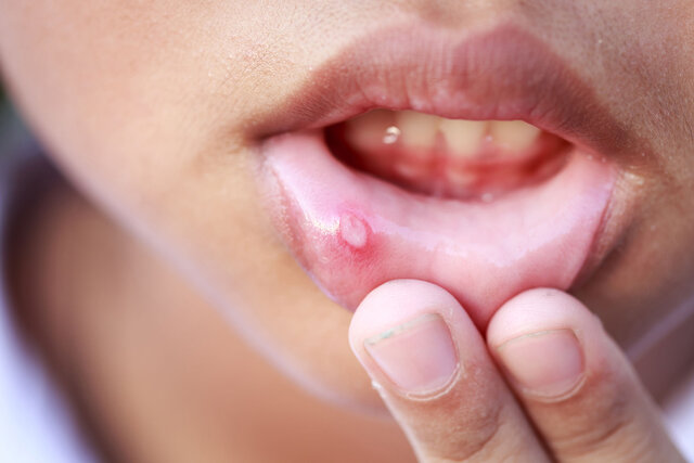 عامل افزایش دهنده زخم‌های ناشی از آفت دهان
