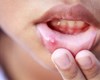 عامل افزایش دهنده زخم‌های ناشی از آفت دهان