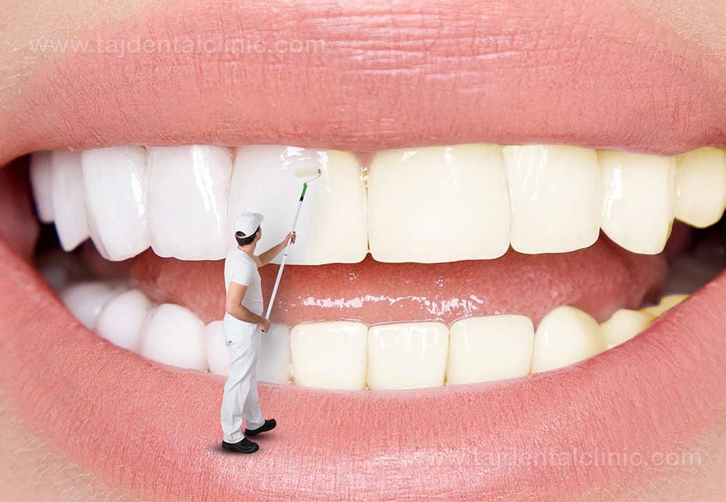 آیا سفید کردن دندان ها کاری اشتباه  است؟