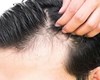 ریزش مو؛ عوارض جدید ابتلا به کووید ۱۹