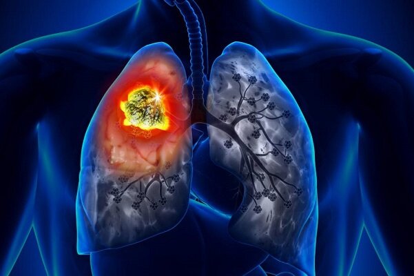 روغن کانابیدیول تومورهای سرطان ریه را کوچک می کند